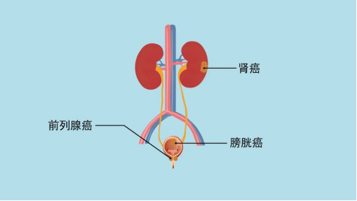 提醒老年人，要警惕这3类高发疾病，早预防早受益